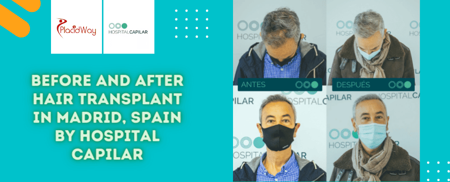 Cirugía de trasplante capilar antes y después en Madrid, España, por Hospital Capilar