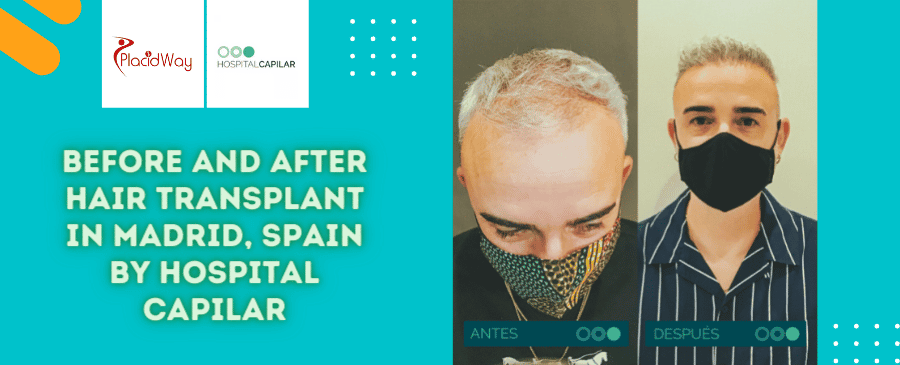 Cirugía de trasplante capilar antes y después en Madrid, España, por Hospital Capilar