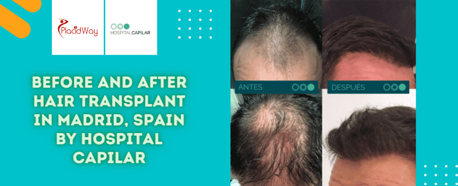 Cirugía de trasplante capilar antes y después en Madrid, España, por Hospital Capilar