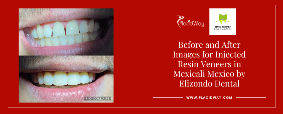 Fotografías de antes y después de atención dental en Mexicali, México, por EDG