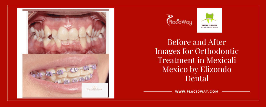 Fotografías de antes y después de atención dental en Mexicali, México, por EDG