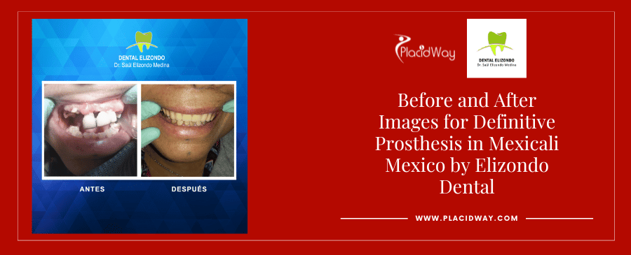 Fotografías de antes y después de atención dental en Mexicali, México, por EDG