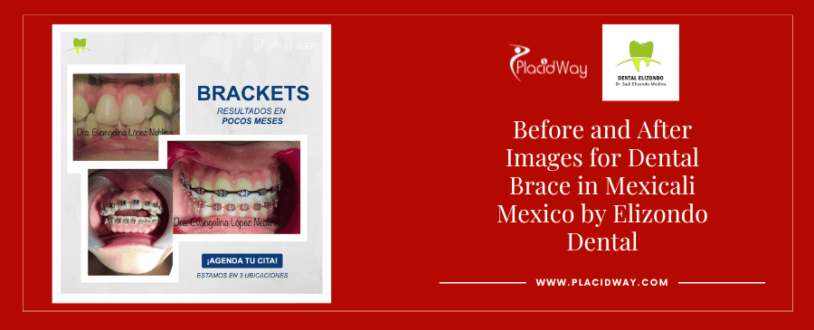Fotografías de antes y después de atención dental en Mexicali, México, por EDG