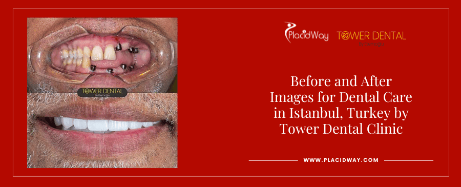 Before and After Dental Implants in Istanbul Turkey