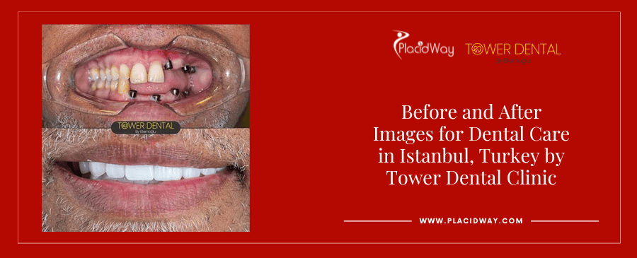 Before and After All on 6 Implants in Istanbul Turkey