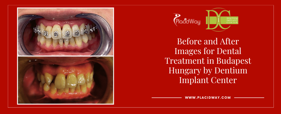 Фотографии до и после лечения зубов в Будапеште, Венгрия