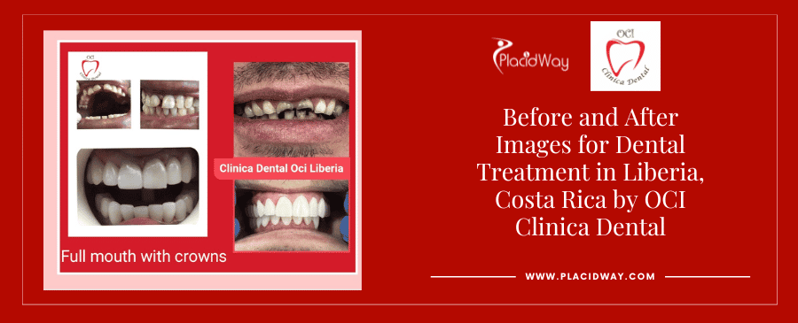 Imágenes de antes y después de un tratamiento dental en Liberia, Costa Rica por OCI Clinica Dental