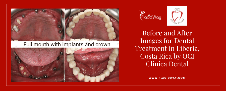 Imágenes de antes y después de un tratamiento dental en Liberia, Costa Rica por OCI Clinica Dental