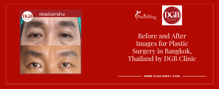Vor und nach der plastischen Chirurgie in Bangkok, Thailand