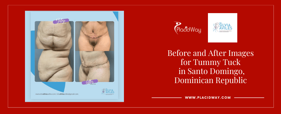 Abdominoplastia en Santo Domingo República Dominicana Antes y Después