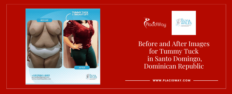 Abdominoplastia y levantamiento de senos en Santo Domingo República Dominicana Antes y Después