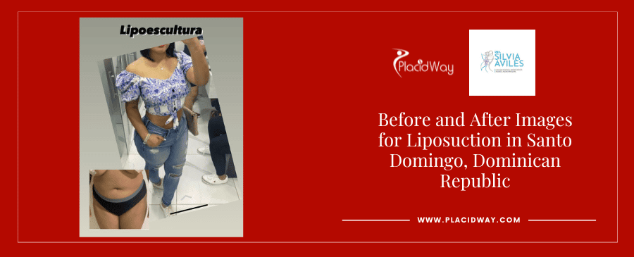 Lipo y BBL en Santo Domingo República Dominicana Antes y Después