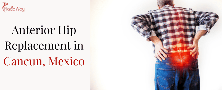 Reemplazo de cadera anterior en Cancún, México Anterior Hip Replacement in Cancun, Mexico