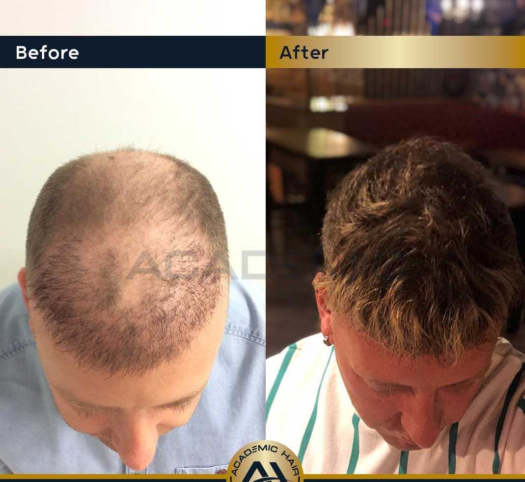Trasplante de cabello en el hospital académico antes y después