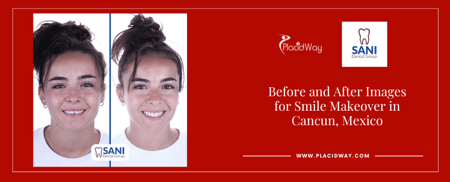 Imágenes de antes y después de un cambio de imagen de sonrisa en Cancún, México