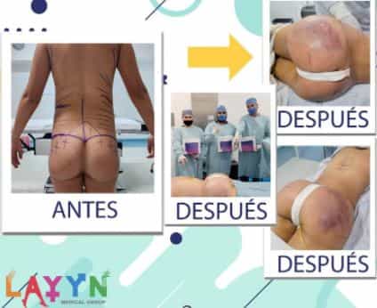 IMÁGENES ANTES Y DESPUÉS DE LAYYN