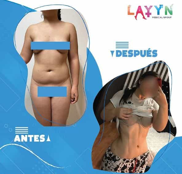 Tummy Tuck in Tijuana Before After Picture