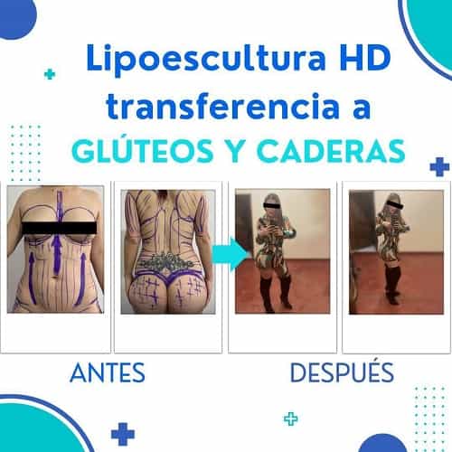 Imágenes de antes y después de liposucción en Tijuana, México