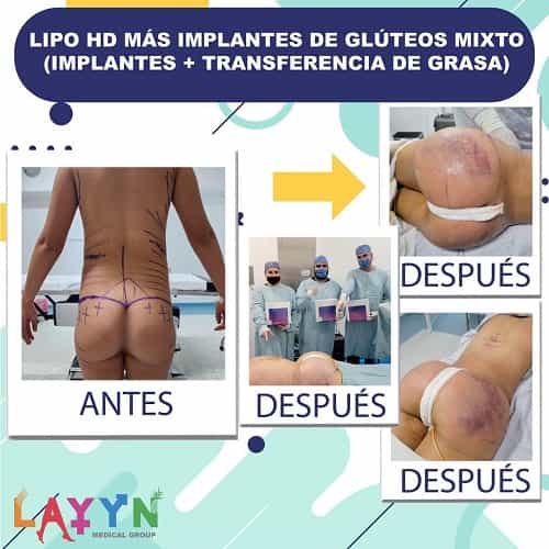 Imágenes de antes y después de liposucción en Tijuana, México