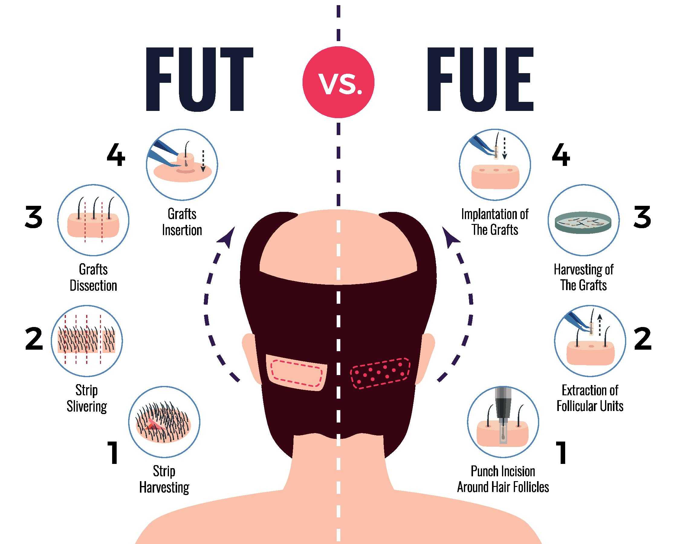 Types of Hair Transplant Types of Hair Transplant