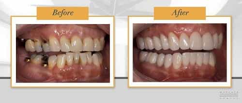 Antes y después de una transformación de sonrisa en Puerto Vallarta, México