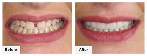 Antes y después de la colocación de brackets en Puerto Vallarta, México