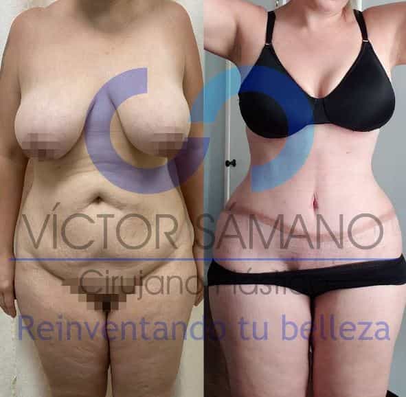 Mommy Makeover en Cancún, México