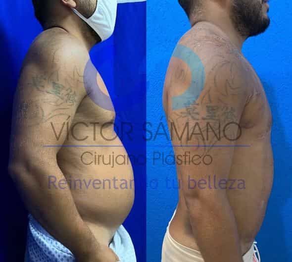 lipo en cancun mexico