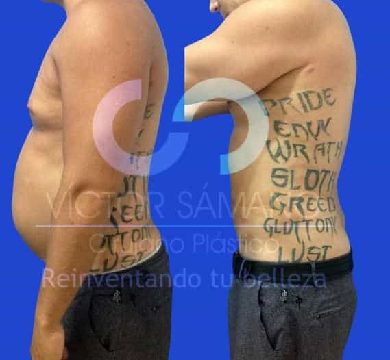 lipo en cancun mexico victor samano