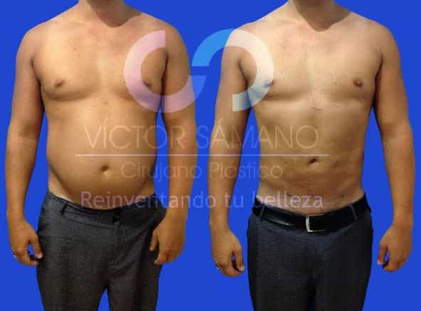 Imágenes de antes y después de una abdominoplastia en Cancún, México