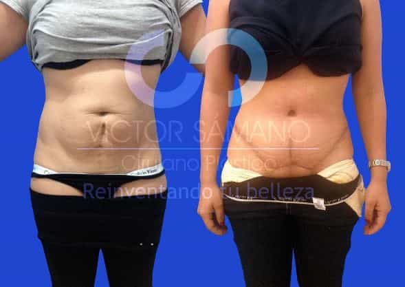 Abdominoplastia en Cancún, México Fotos de antes y después