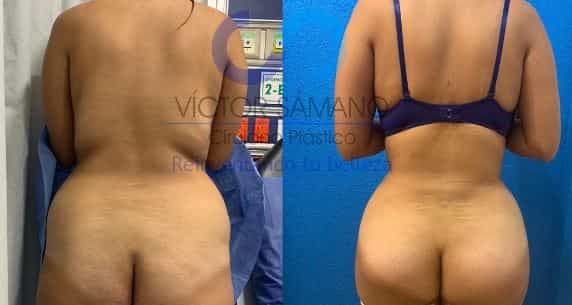 bbl en cancun antes despues