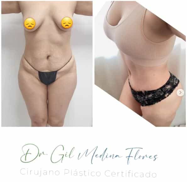 Imágenes de antes y después de MMO en Mérida México