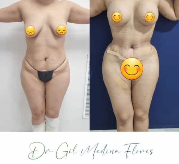 Fotos de antes y después de MMO en Mérida México