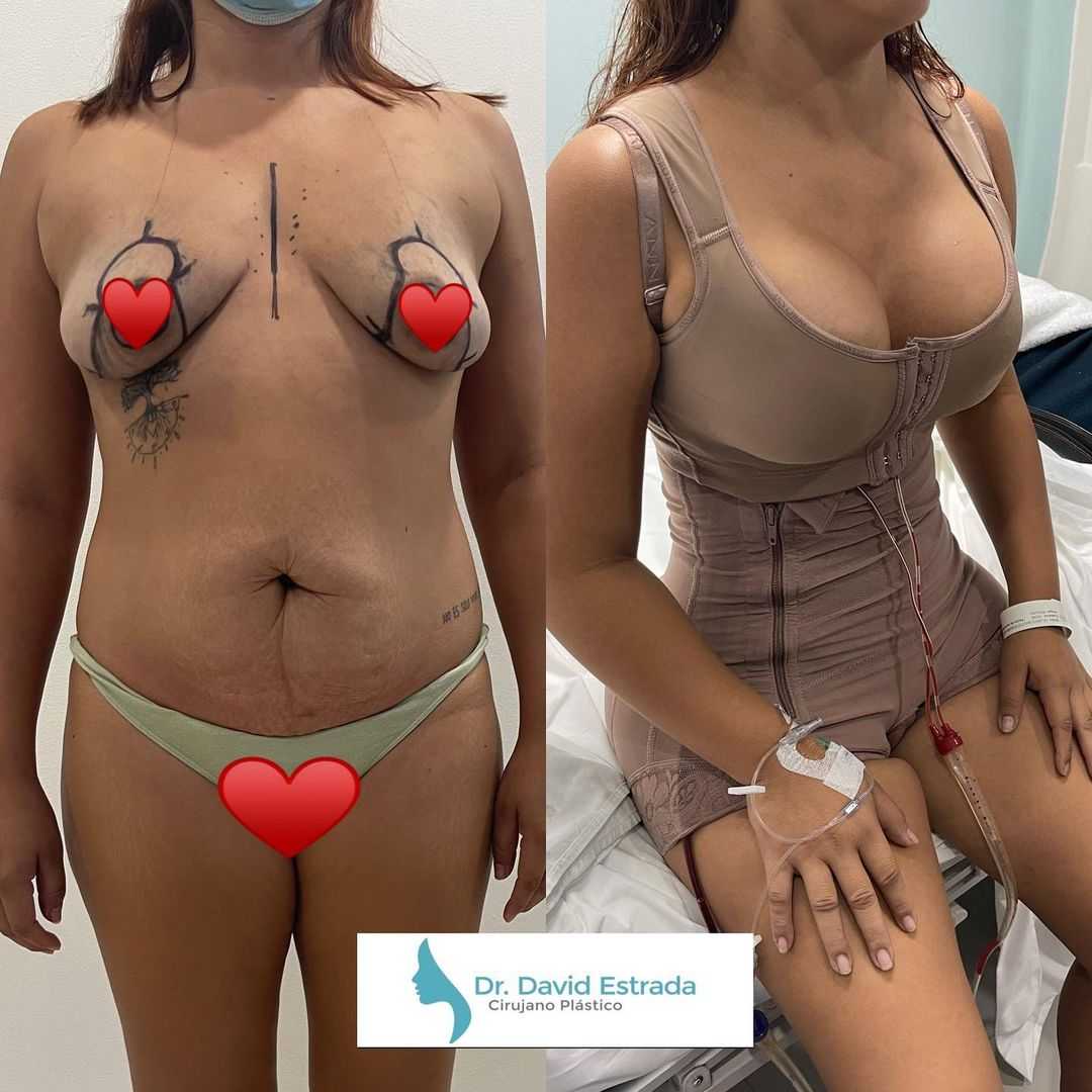 Imágenes de antes y después de Mommy Makeover del Dr. David Estrada