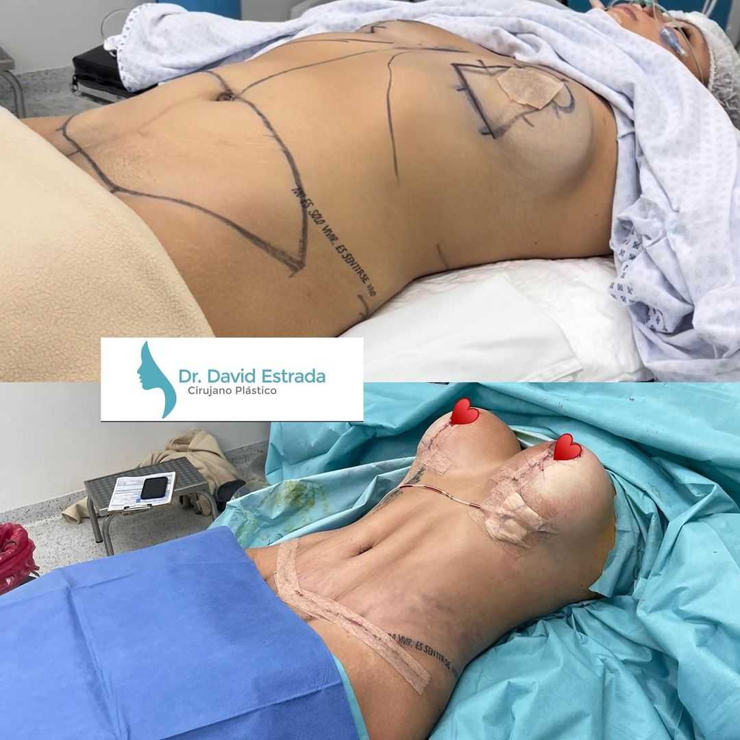 Imágenes de antes y después del Dr. David Estrada Mommy Makeover