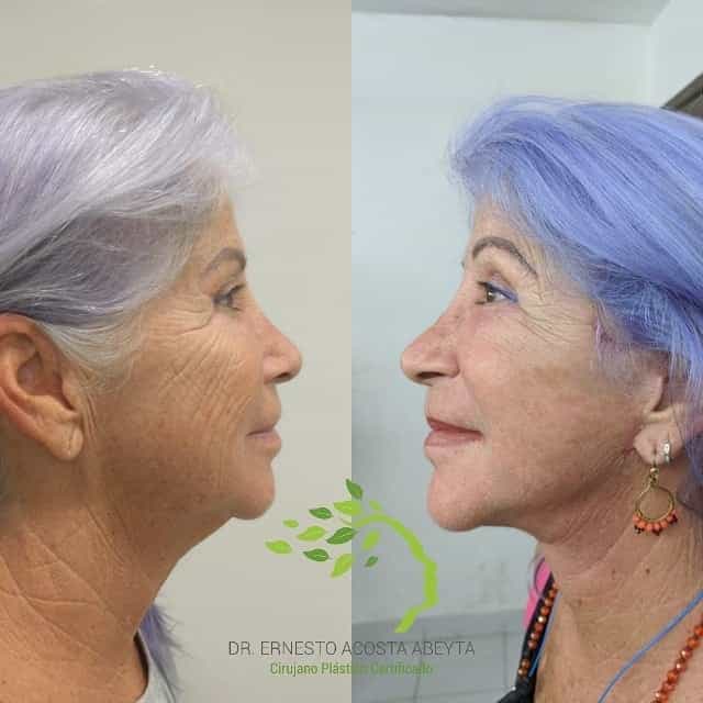 Imágenes de antes y después de un lifting facial en Mérida, México