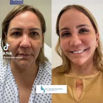 lifting facial en cancun david estrada antes despues