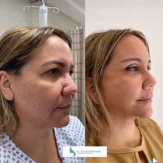lifting facial en cancun david estrada en cancun antes despues
