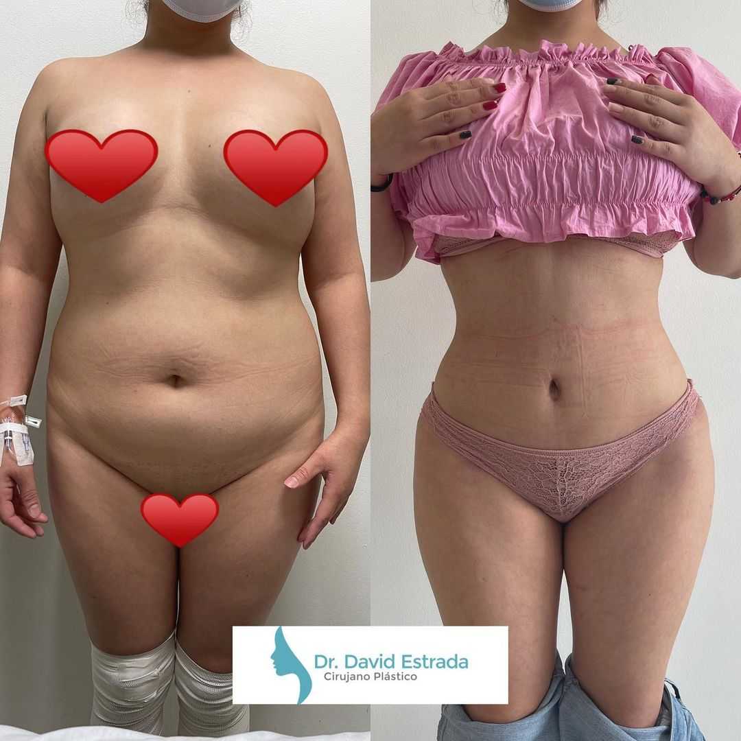 Dr. David Estrada - Lipo Antes Y Despues