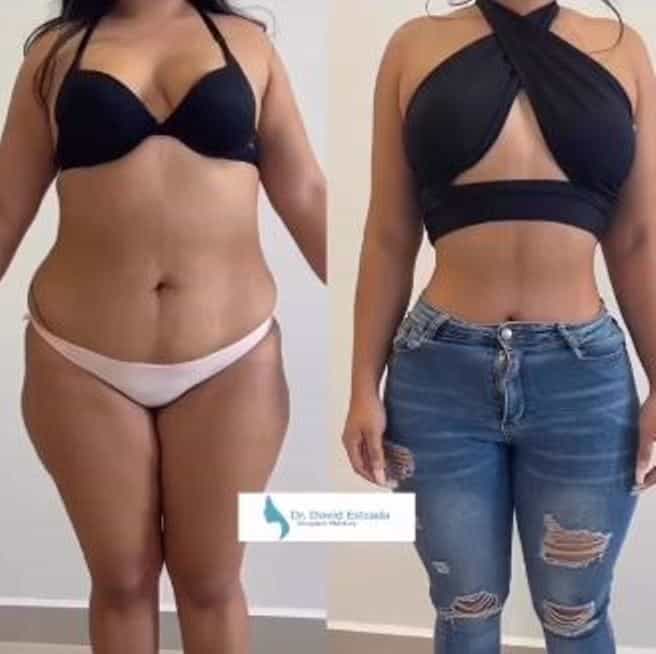 Dr. David Estrada - Lipo Antes y Después en Cancún, México
