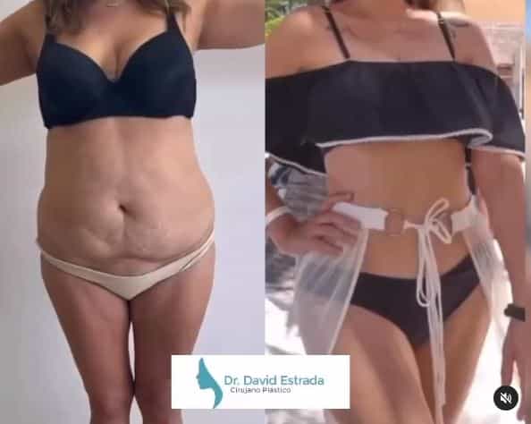Dr. David Estrada en Cancún, México Lipo Antes Después