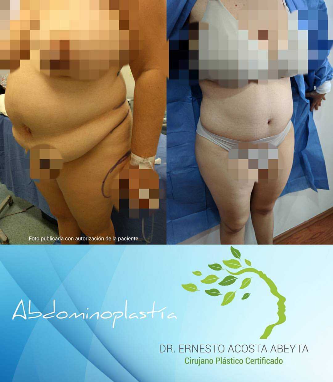 Imágenes de antes y después de una abdominoplastia en Mérida, México
