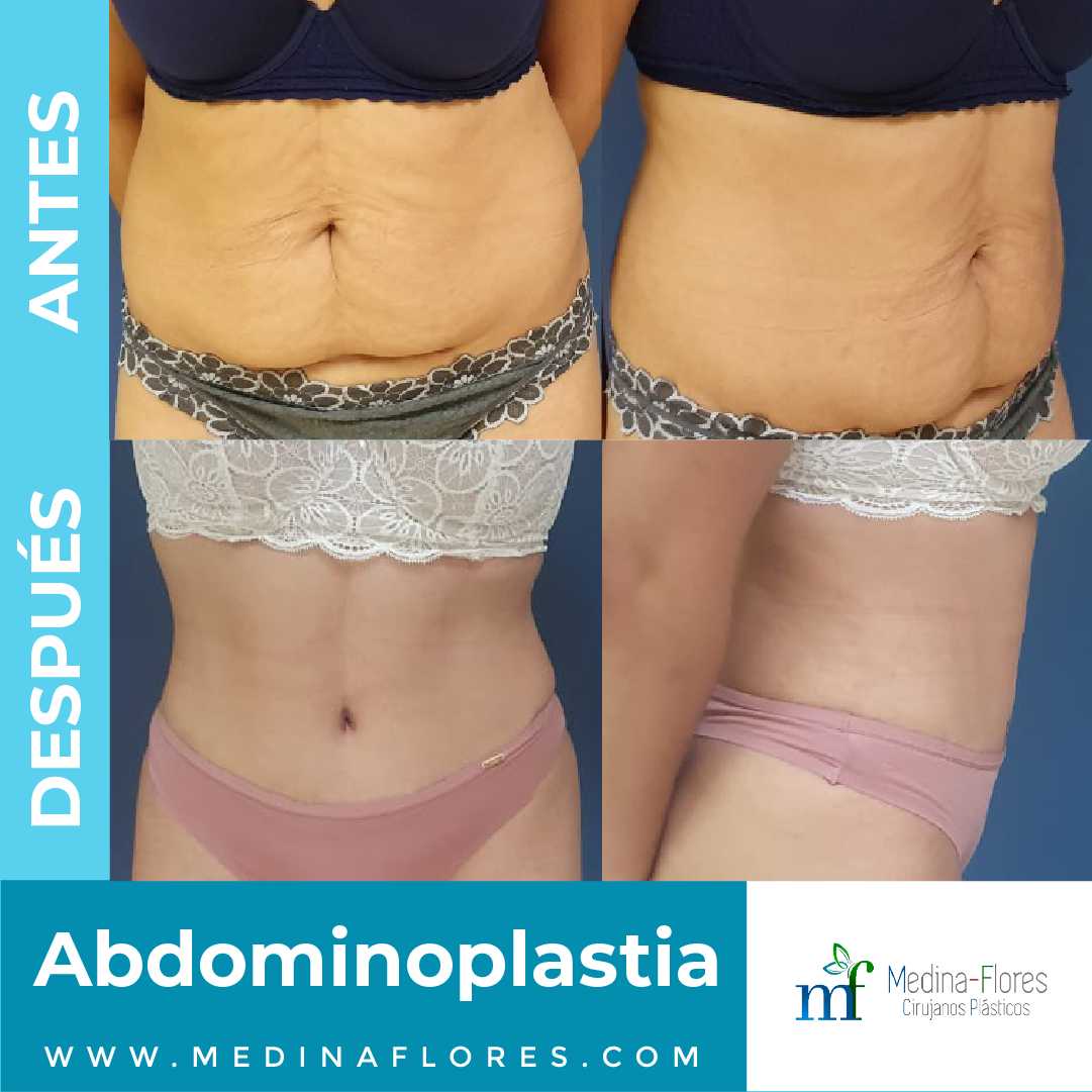 Abdominoplastia antes y después en Mérida, México por Medina Flores