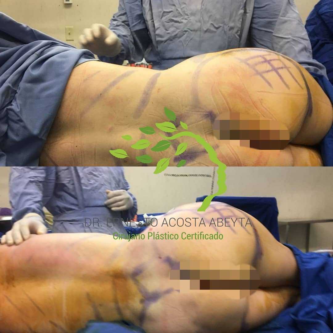 BBL en Mérida, México Ernesto Abeyta Imágenes Antes y Después