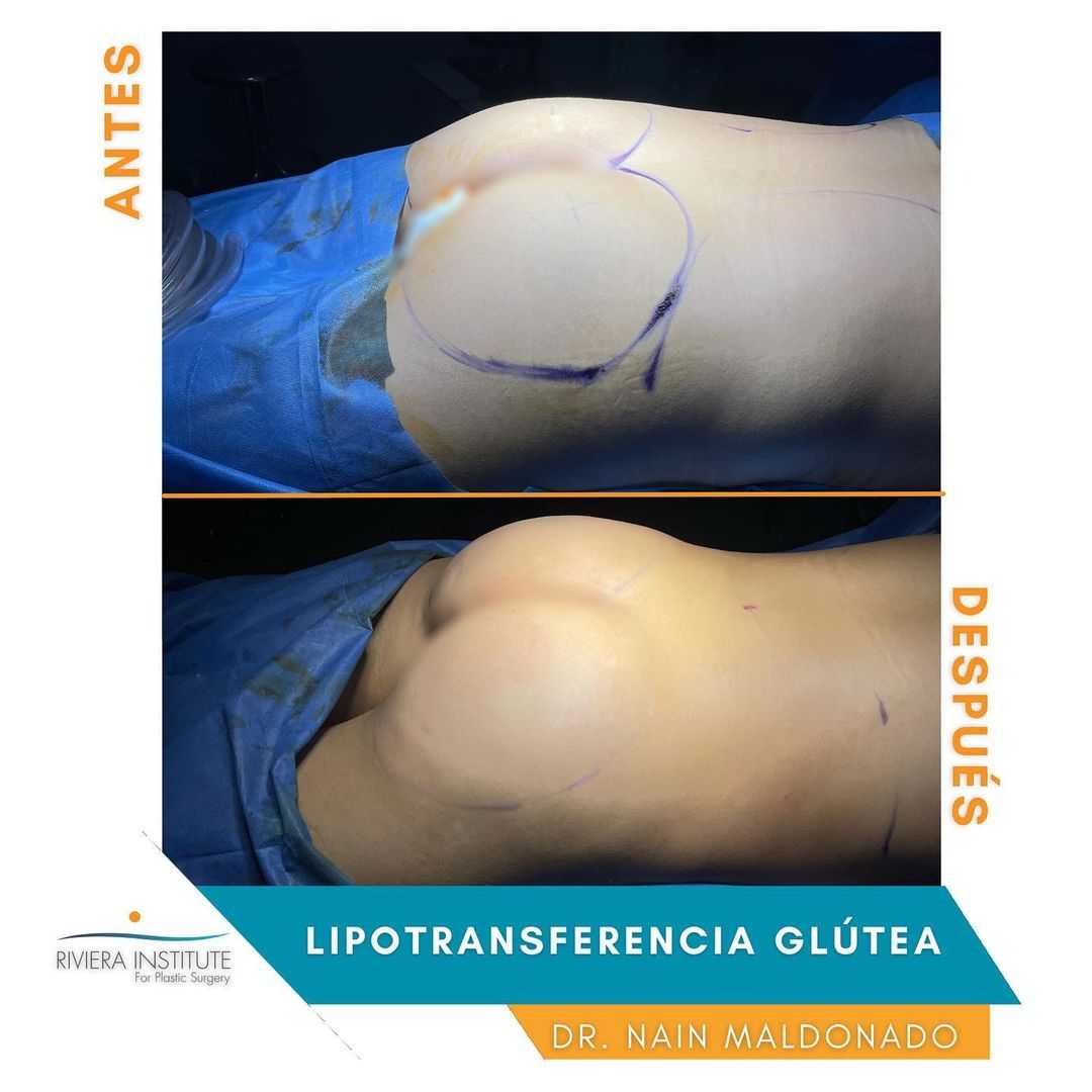 Imágenes de antes y después del paquete de levantamiento de glúteos brasileño en Cancún, México