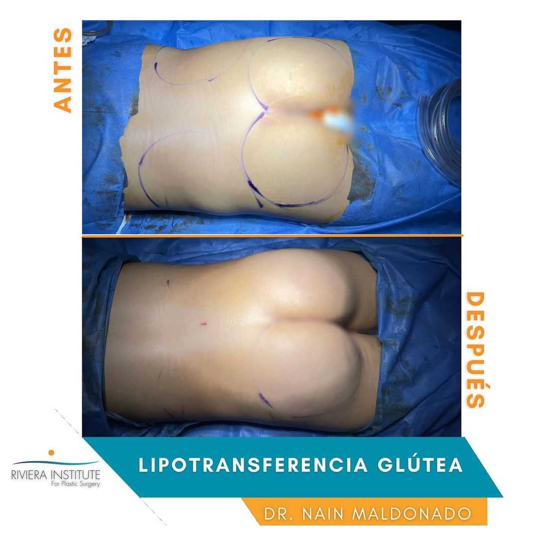 Paquete de levantamiento de glúteos brasileño en Cancún, México Fotos de antes y después