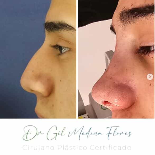 Rinoplastia en Mérida, México Fotos de Antes y Después