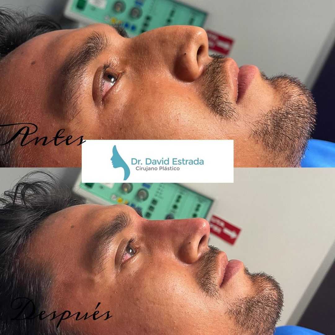 Imágenes de antes y después de rinoplastia del Dr. David Estrada en Cancún, México