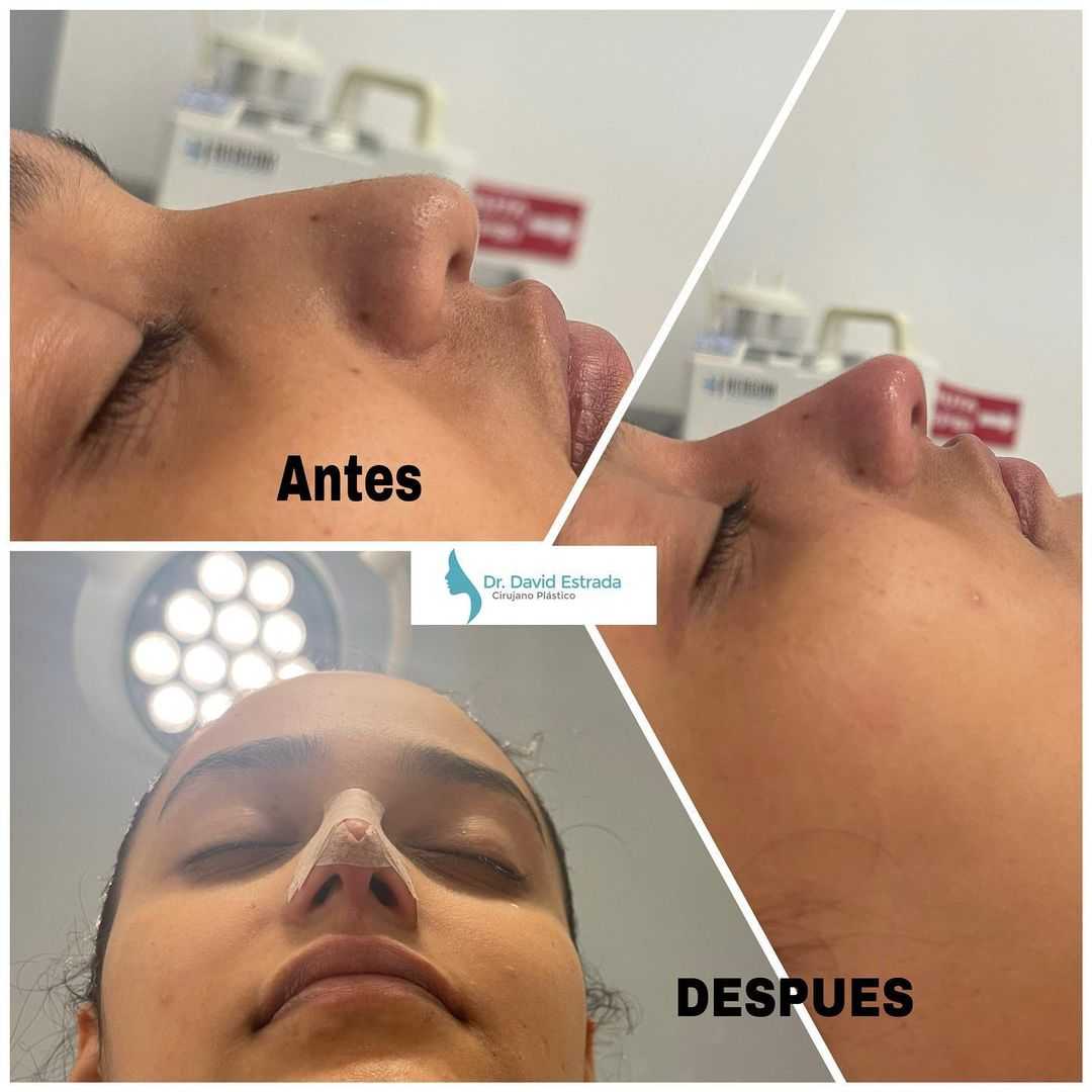 Imágenes de antes y después de la cirugía de nariz del Dr. David Estrada en Cancún, México